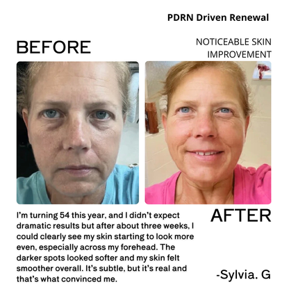 Before and after comparison of a woman's skin with text about PDRN-driven renewal and visible skin improvement.